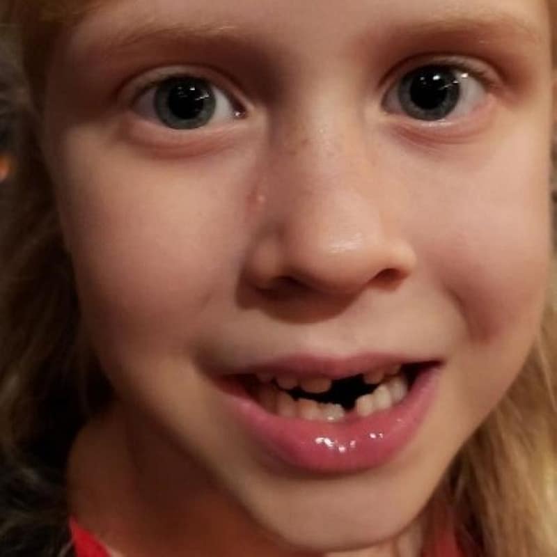 Little Girl (Maddy) with Missing Teeth